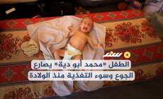 الطفل «محمد أبو دية» يصارع الجوع وسوء التغذية منذ الولادة