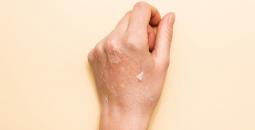 تشققات جلد بشرة اليدين.jpg