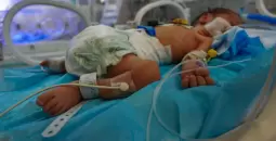 تشوه الاجنة