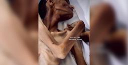 استشهاد شاب نتيجة سوء التغذية في مستشفى ناصر