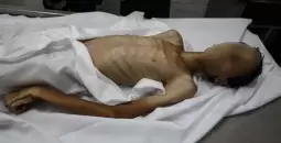 وفاة فتى بسبب المجاعة بغزة