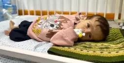 طفل في غزة يُعاني من سوء التغذية.webp