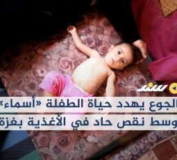 الجوع يهدد حياة الطفلة 