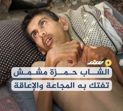 الشاب حمزة مشمش تفتك به المجاعة والإعاقة