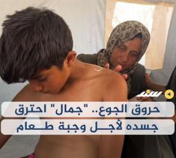 حروق الجوع.. 