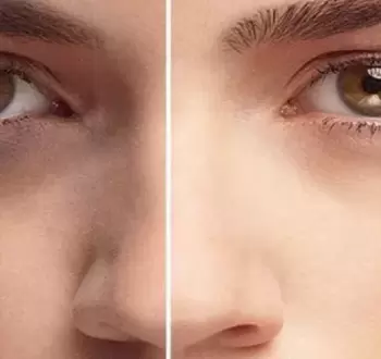 التخلص من الهالات السوداء
