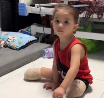 طفلة بترت ساقاها بقصف إسرائيلي على غزة