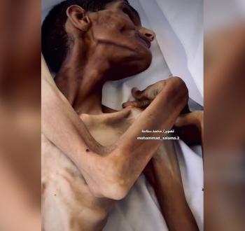 استشهاد شاب نتيجة سوء التغذية في مستشفى ناصر
