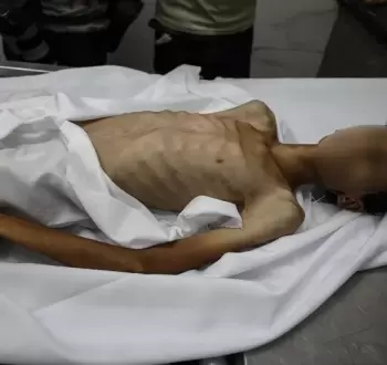 وفاة فتى بسبب المجاعة بغزة