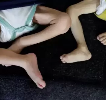 مرض الشلل المتصاعد.