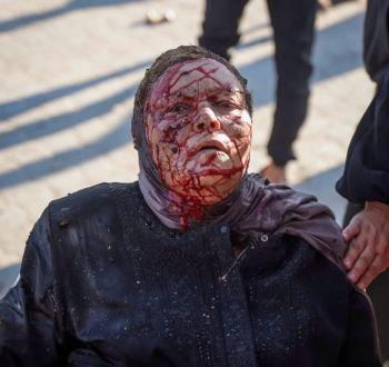 سيدة مصابة إثر مجزرة الميناء بغزة