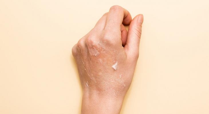 تشققات جلد بشرة اليدين.jpg