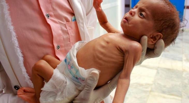 سوء التغذية في شمال غزة