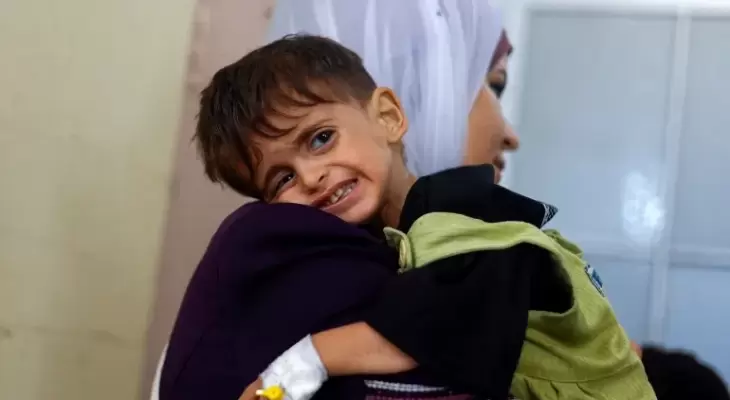 طفل يعاني من شلل الاطفال.webp