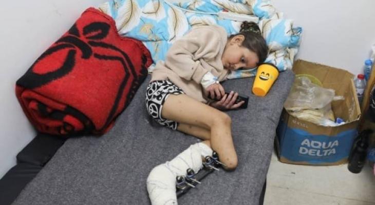 طفلة مبتورة الأطراف بغزة بسبب الحرب الإسرائيلية