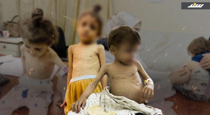 سوء التغذية في قطاع غزة