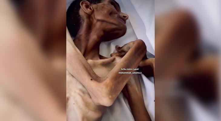 استشهاد شاب نتيجة سوء التغذية في مستشفى ناصر