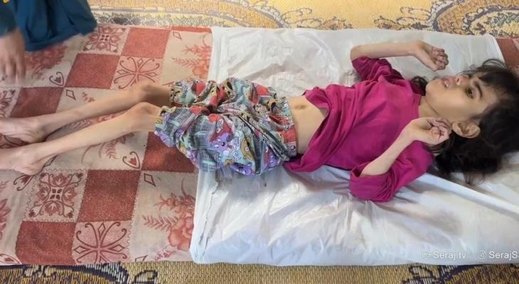 استشهاد طفلة بسبب سوء التغذية