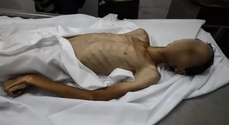 وفاة فتى بسبب المجاعة بغزة