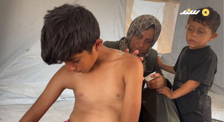 حروق الجوع.. جمال احترق جسده لأجل وجبة طعام