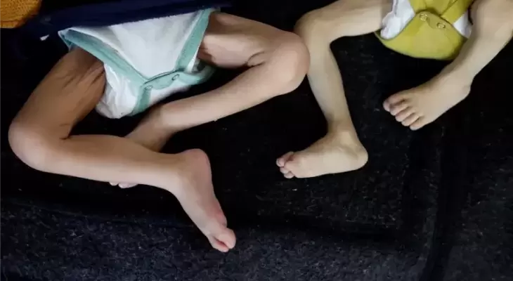مرض الشلل المتصاعد.