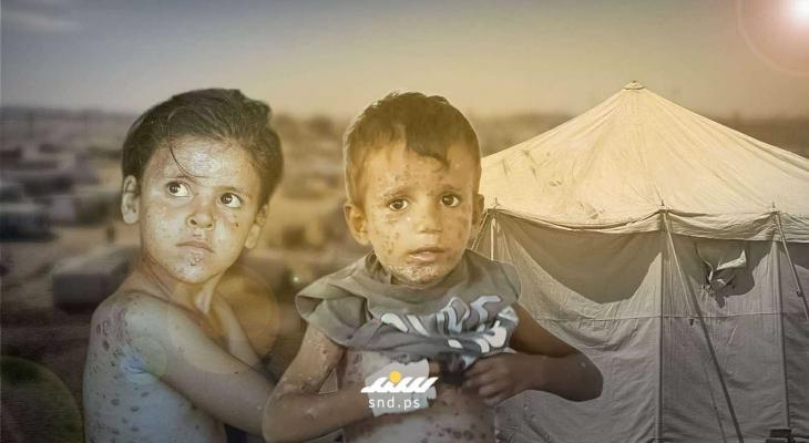 أمراض جلدية تنهش أجساد النازحين في غزة.. حرارة وحصار دون علاج
