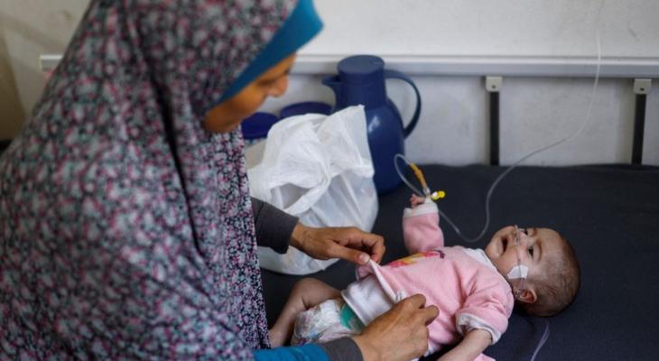 طفل يُعاني من سوء التغذية في غزة.jpg