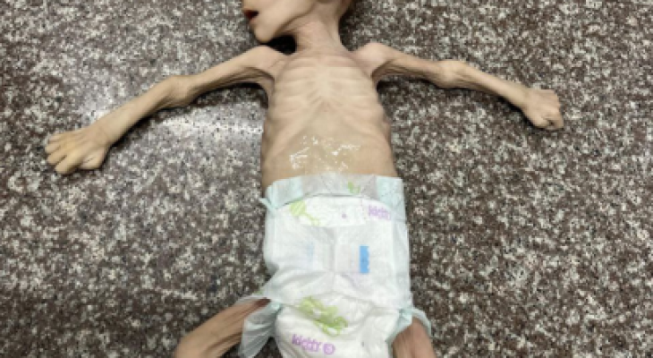 وفيات سوء التغذية.png