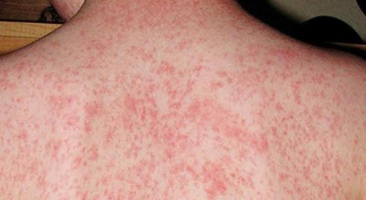 الحصبة
