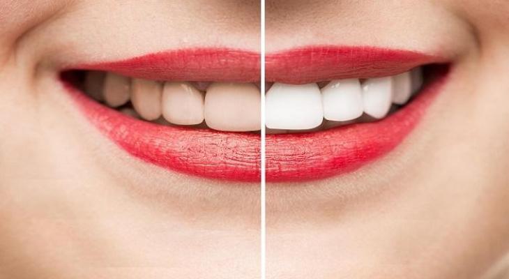 ابتسامة ناصعة البياض: أسرار الأعشاب الطبيعية لتبييض الأسنان