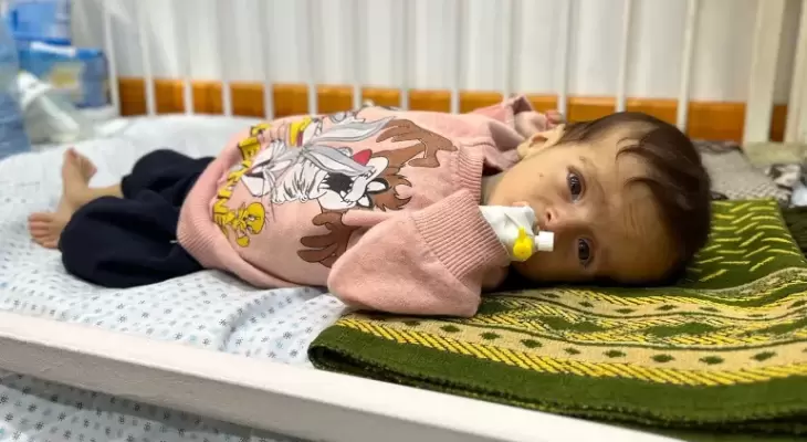 طفل في غزة يُعاني من سوء التغذية.webp