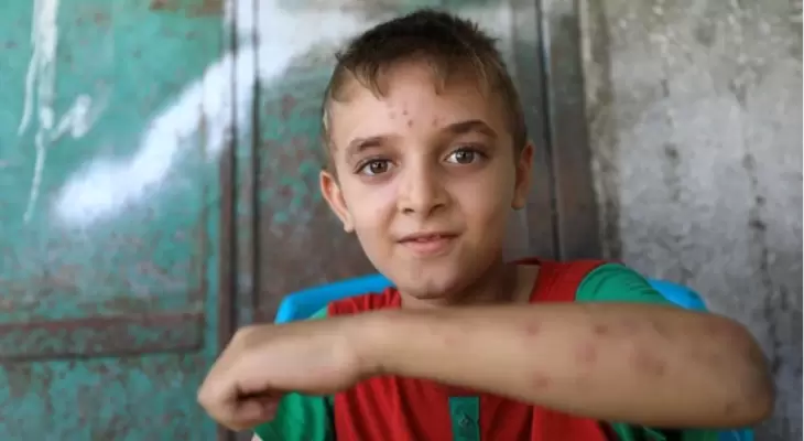 إصابة العديد من أطفال غزة بأمراض جلدية نتيجة تلوث المياه