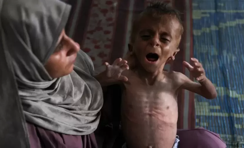 التقزم يفضح آثار التجويع الإسرائيلي في غزة