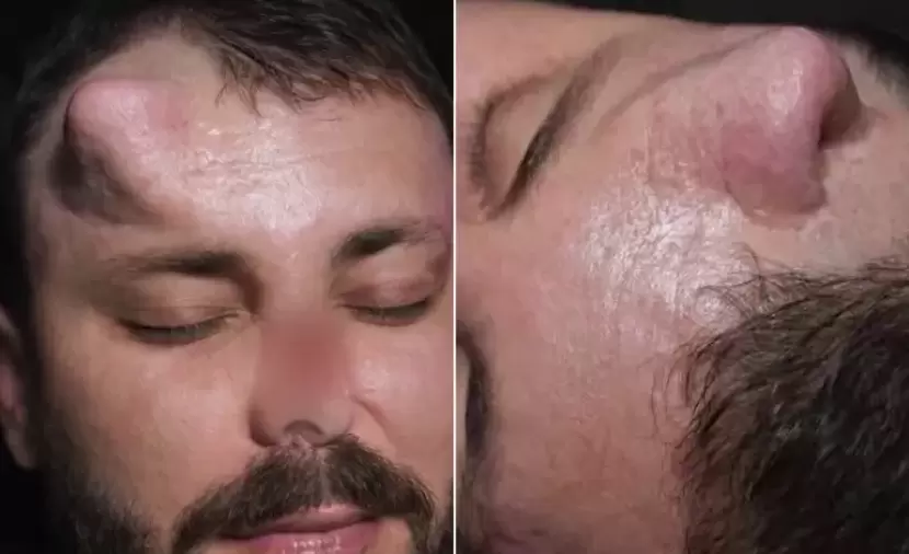 جرّاح عراقي يعيد بناء أنف في جبين مريض