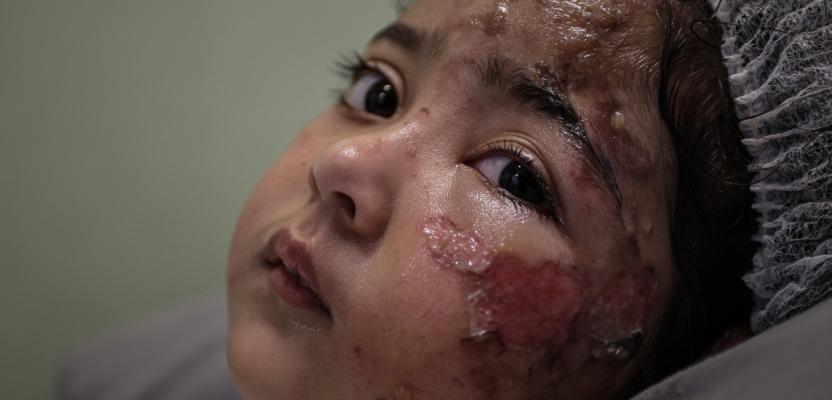 طفولة يتيمة...مريم تُصارع جراح الحروق ويتم الاستشهاد في غزة المحاصرة