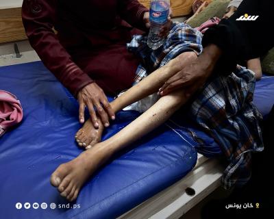 رصاصة إسرائيلية تشل طفولة ميس عبد العال بعد إصابتها داخل خيمتها4.jpg
