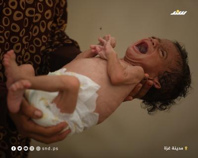 الرضيع سالم عوض.. 6 أشهر من الحياة على حافة الموت بسبب المجاعة (3).jpeg