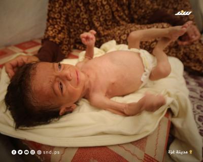 الرضيع سالم عوض.. 6 أشهر من الحياة على حافة الموت بسبب المجاعة (2).jpeg