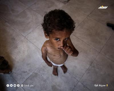 الطفل يزن أبو فول يعاني من سوء التغذية الحاد في ظل استمرار الحصار وشح الغذاء والدواء3.jpg