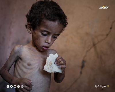 الطفل يزن أبو فول يعاني من سوء التغذية الحاد في ظل استمرار الحصار وشح الغذاء والدواء1.jpg