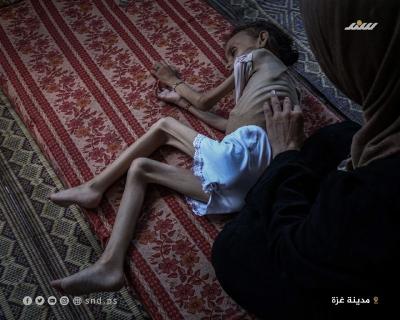 الطفلة مريم دواس تعاني وء تغذية حاد  (7).jpg