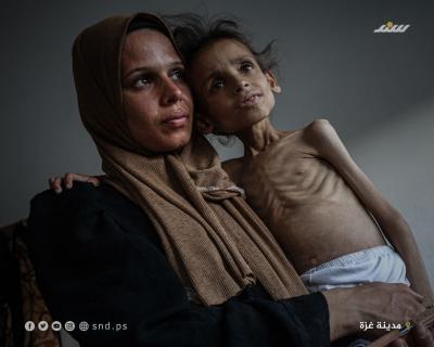 الطفلة مريم دواس تعاني وء تغذية حاد  (6).jpg