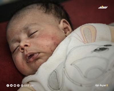 إصابة رضيع بعضة فأر بغزة  (2).jpg