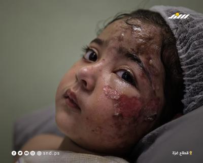 مريم تُصارع جراح الحروق ويتم الاستشهاد في غزة المحاصرة4.jpg